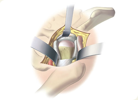 Anterior supine incision