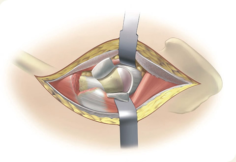 Anterolateral incision