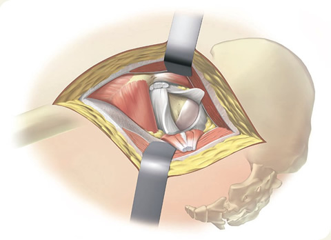 Posterior incision