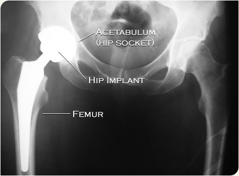 Metal on metal hip prosthesis